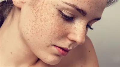 هل يزداد النمش في الصيف؟ استشاري يجيب ويقدم نصائح للوقاية