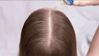طرق طبيعية للعناية بفروة الرأس الدهنية في الصيف