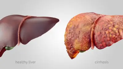 عقار واعد لعلاج الكبد الدهني يظهر نتائج مشجعة في دراسة جديدة