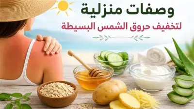 وصفات طبيعية منزلية لتخفيف حروق الشمس البسيطة في الصيف