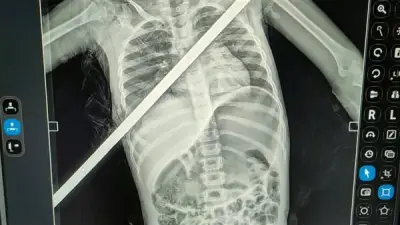 فريق طبي ببنها الجامعية ينقذ حياة طفلة اخترق صدرها سيخ حديدي