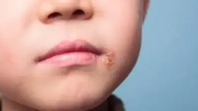 أعراض عدوى فيروس الهربس البسيط: دليل شامل للأنواع المختلفة