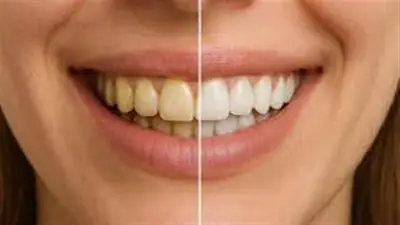 حقيقة المضمضة بالزيت لتبييض الأسنان: فوائد وهمية ومخاطر صحية