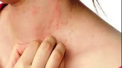 حساسية الصيف.. كل ما تريد معرفته عن حمو النيل وأسبابه وعلاجه