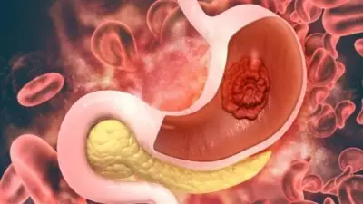 أعراض وأسباب التهاب جدار المعدة وطرق الوقاية الفعالة