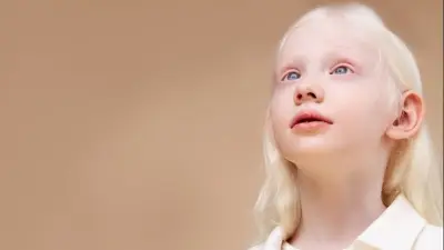 في اليوم العالمي للمهق.. كل ما تود معرفته عن المرض وأعراضه وأسبابه