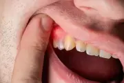 دليلك لصحة الفم: أسباب التهاب اللثة وطرق علاجه الفعالة