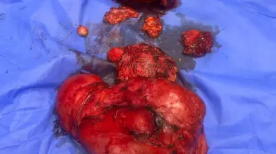 معهد ناصر يستأصل ورمًا سرطانيًا نادرًا وزنه 10 كجم في جراحة 7 ساعات